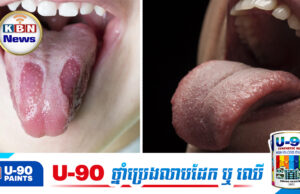 មិនលេងសើចទេ! អណ្តាតរបស់អ្នកអាចប្រាប់ពីសុខភាពក្នុងរាងកាយបានយ៉ាងច្រើន